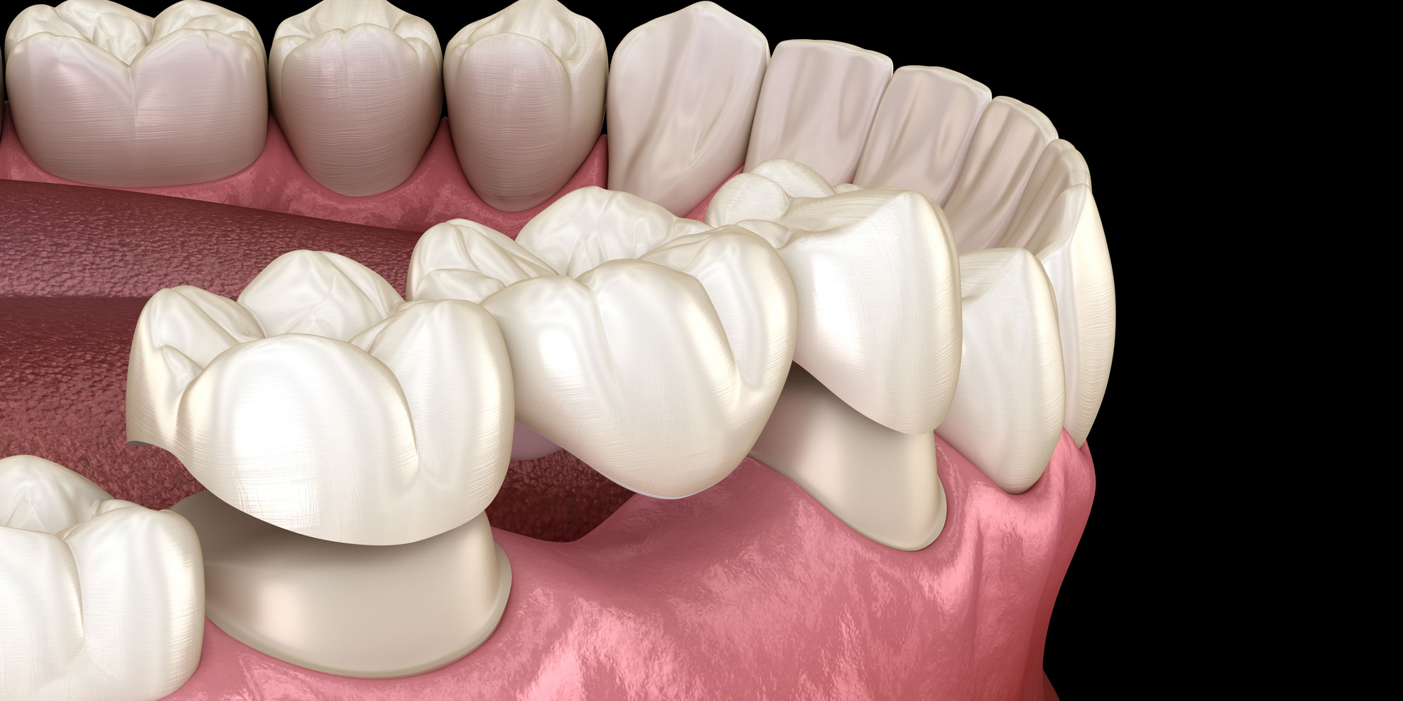 dental bridge model