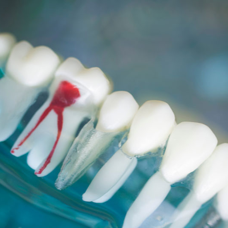 Root Canal Model
