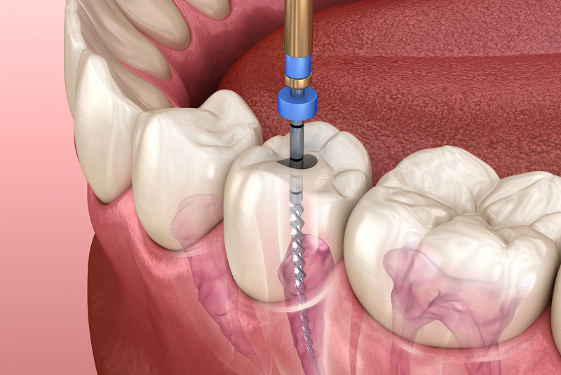 Root canal treatment diagram
