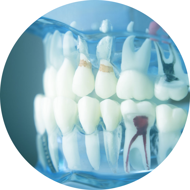 Root Canal model