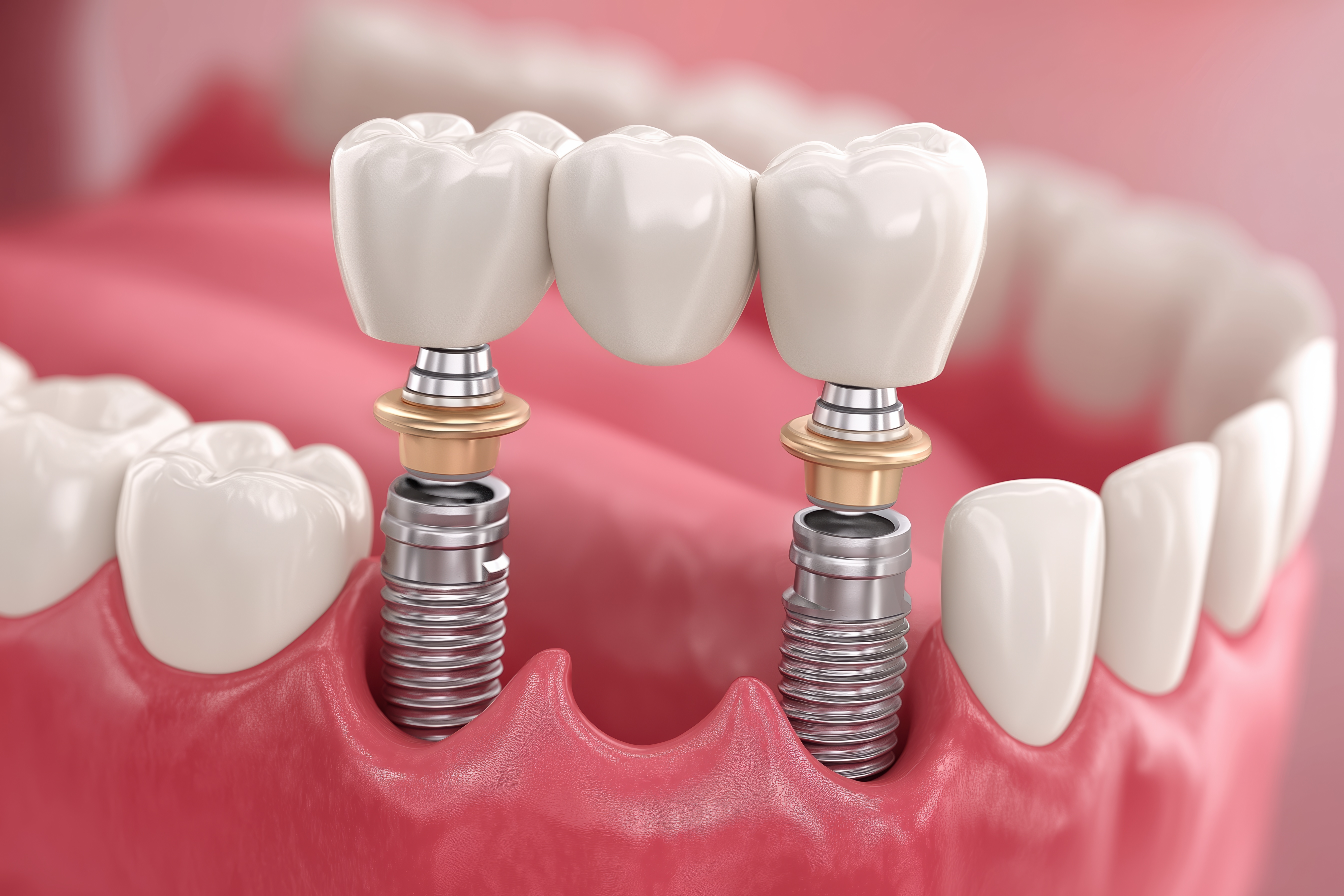 Implant-supported dental bridge