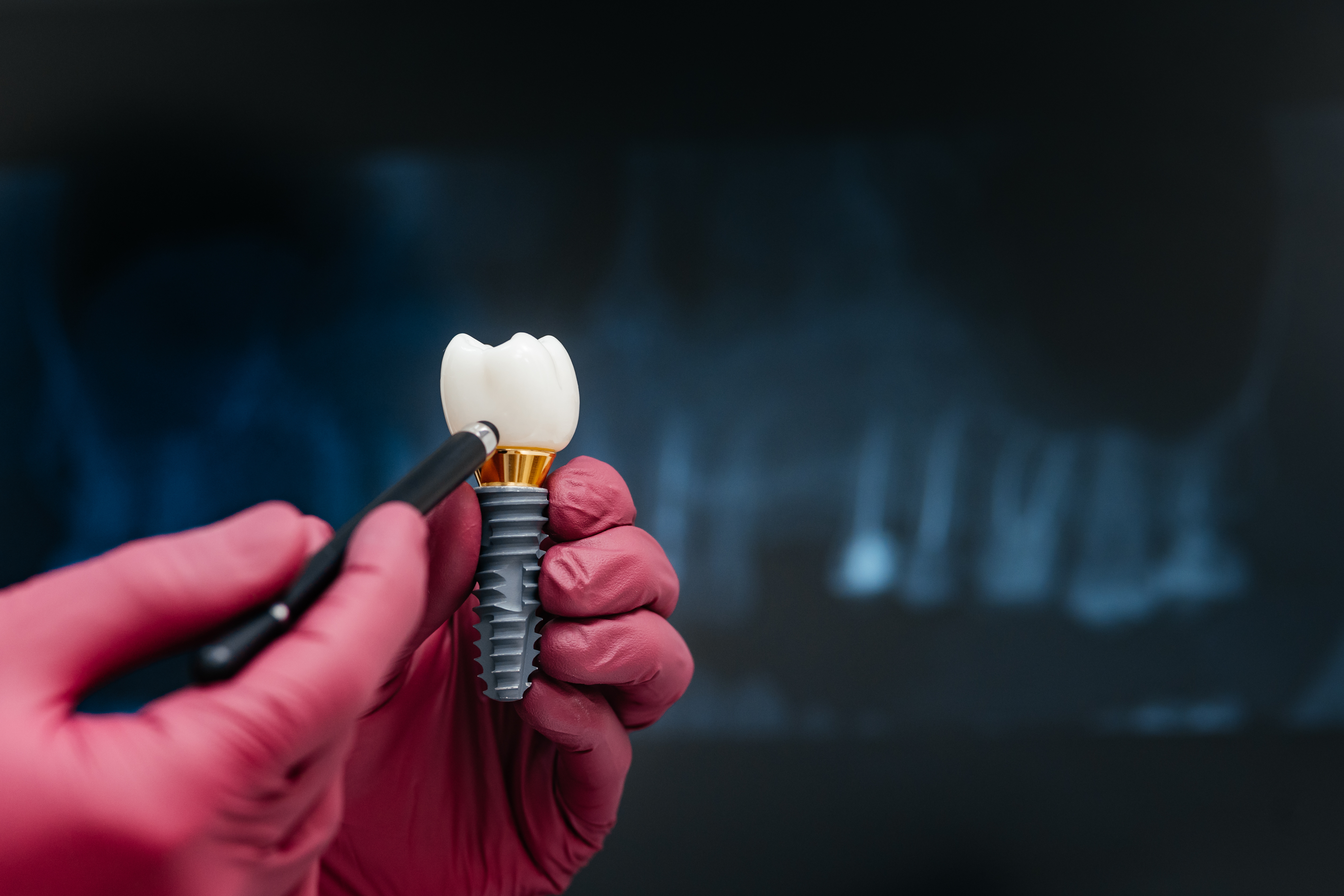 Single dental implant treatment