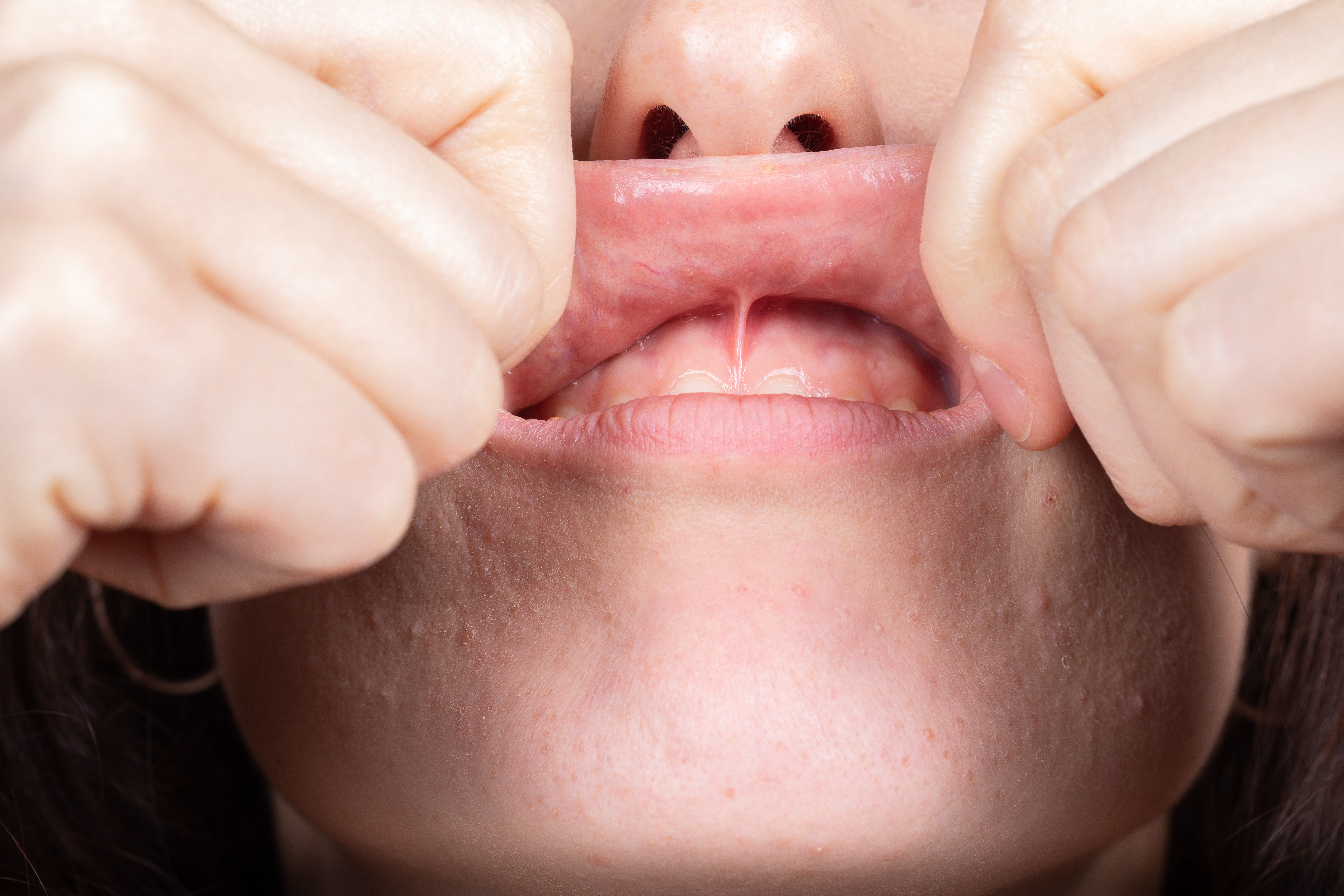 Frenectomy oral procedure