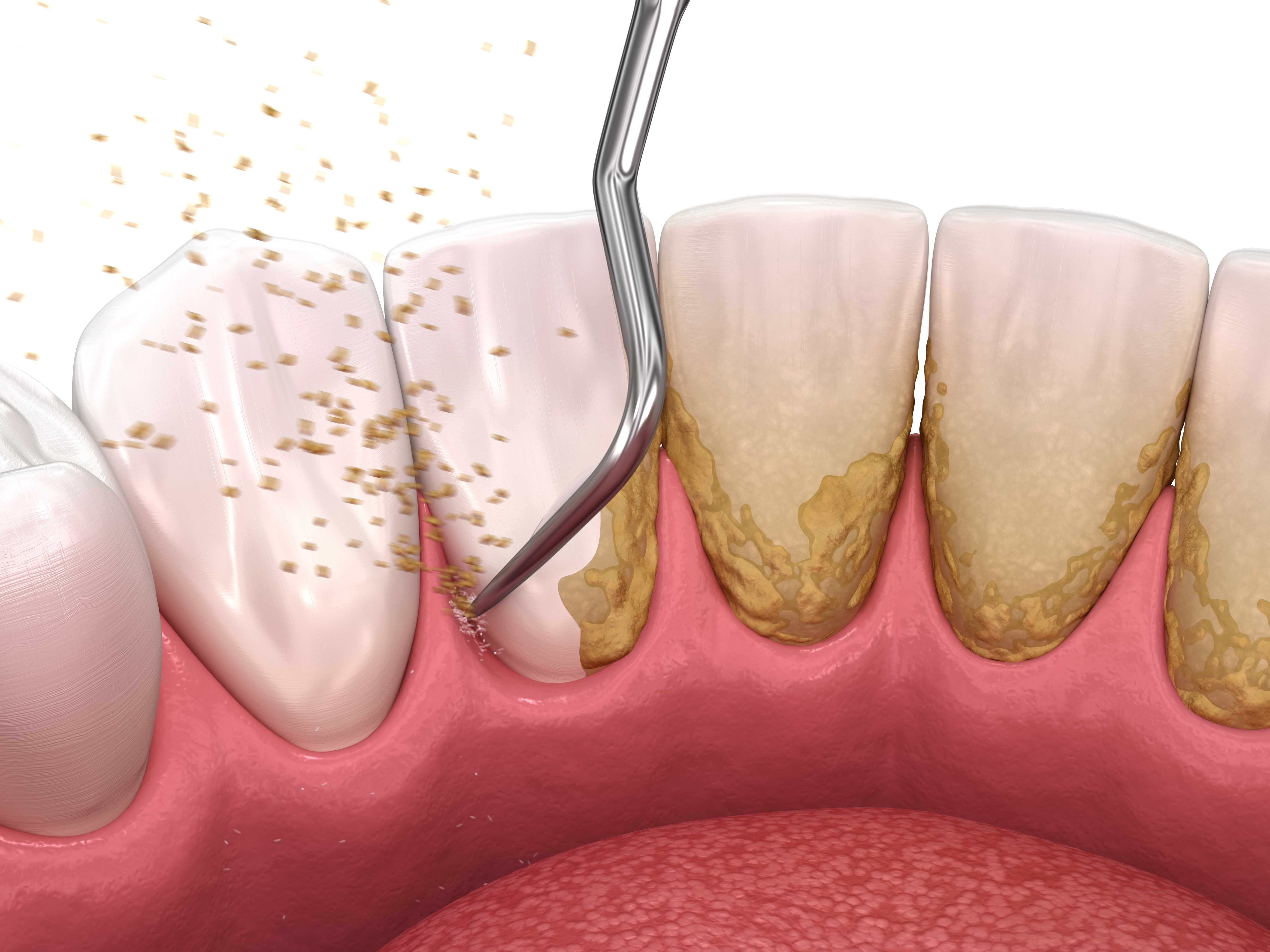 Scaling and root planing periodontal treatment