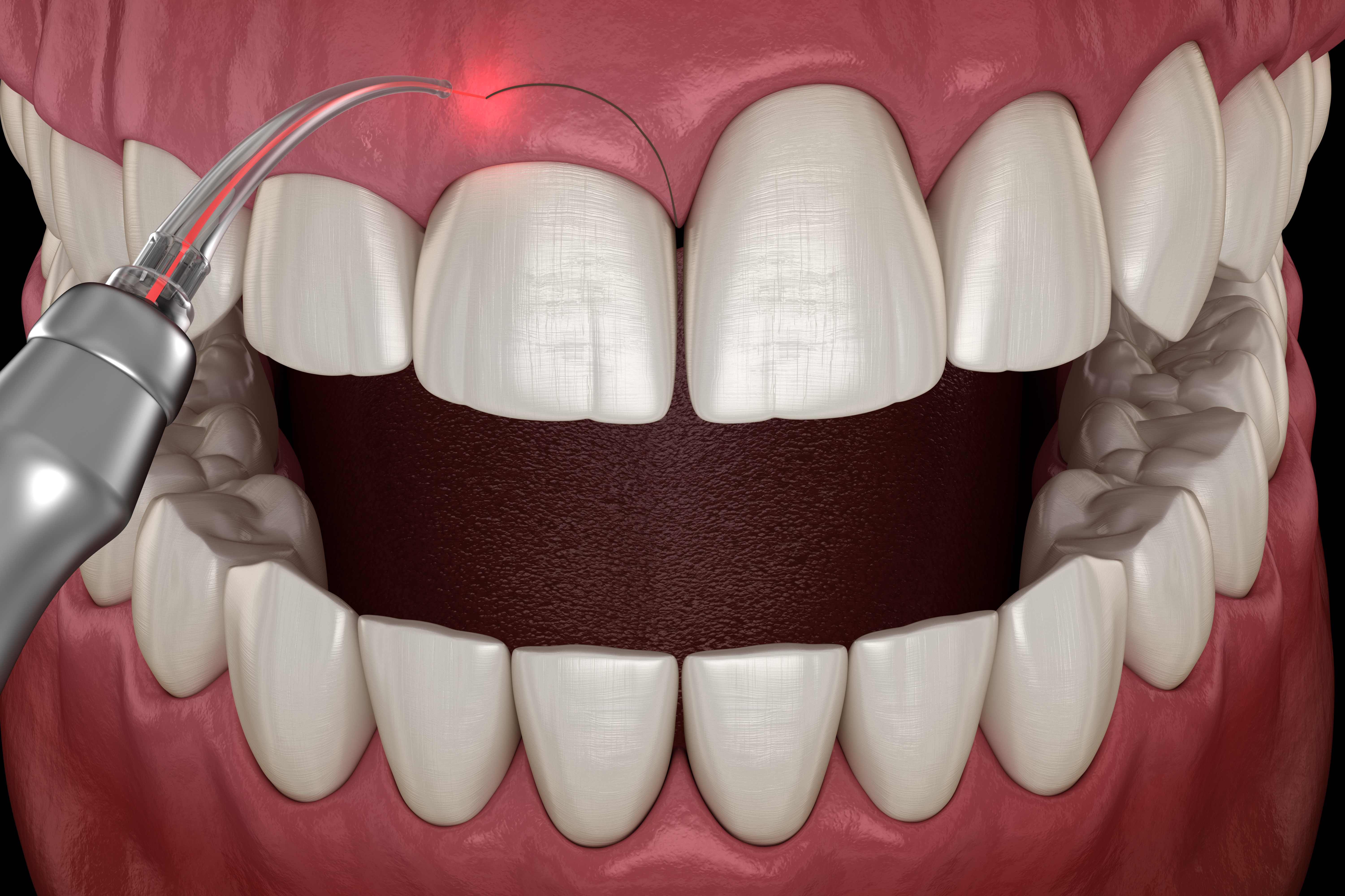 Gingivectomy periodontal procedure