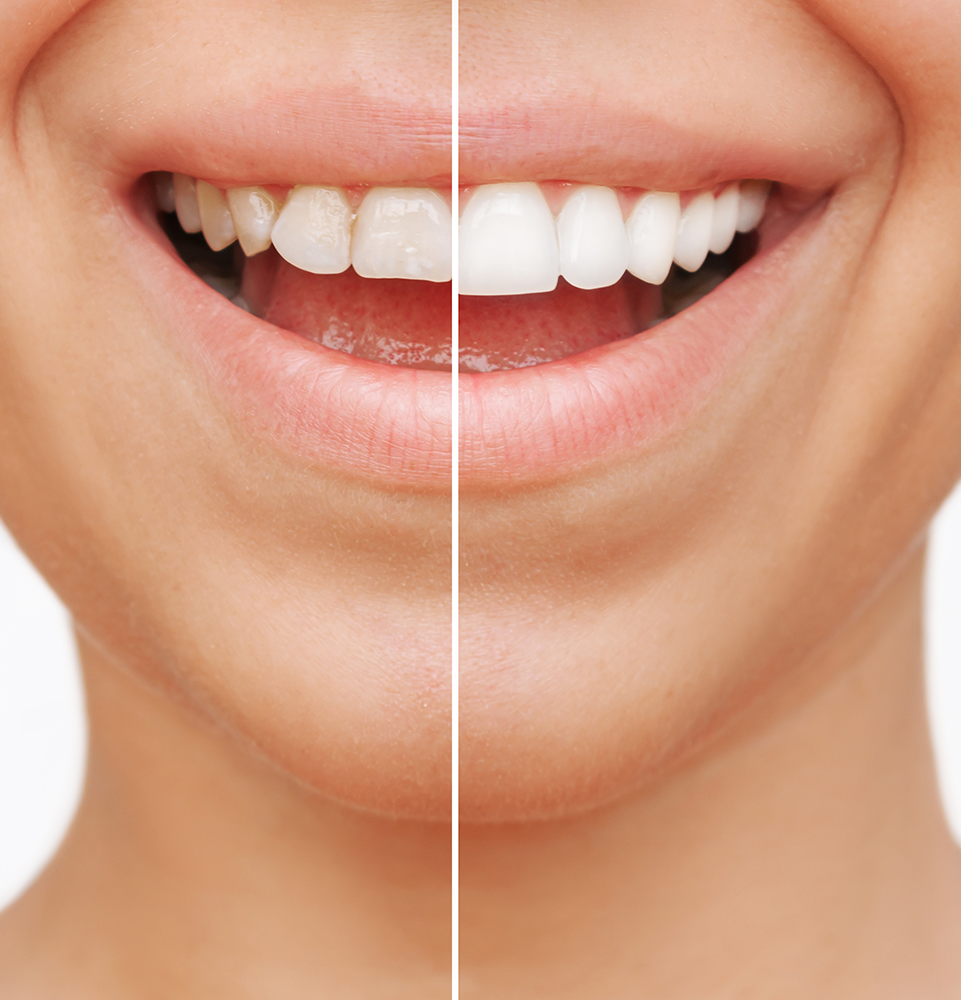 Cosmetic dentistry smile comparison
