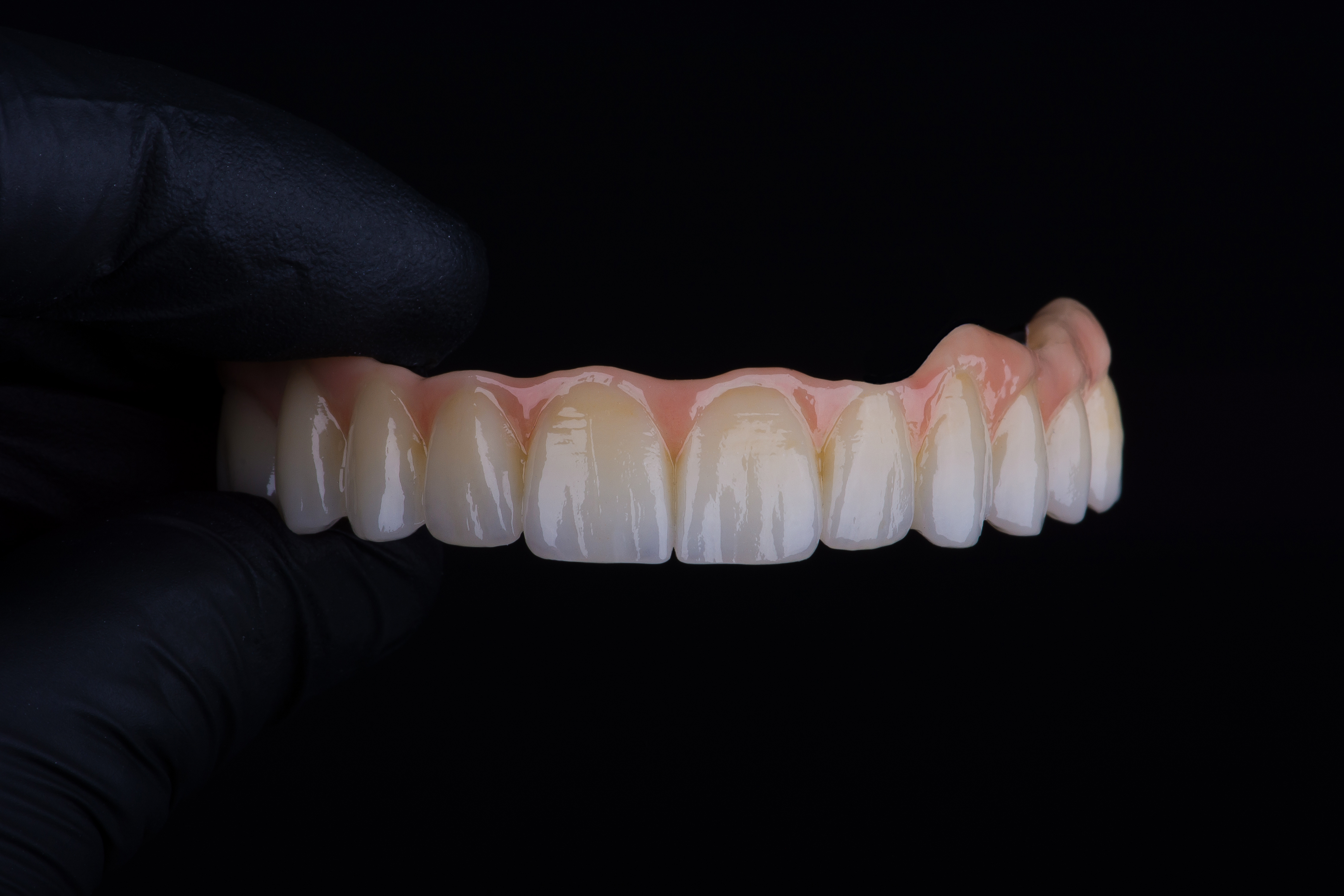 Full-arch dental implant treatment